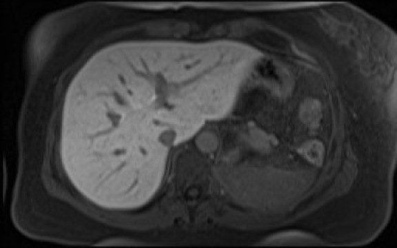 File:Normal hepatobiliary phase liver MRI (Radiopaedia 58968-66230 A 31).jpg