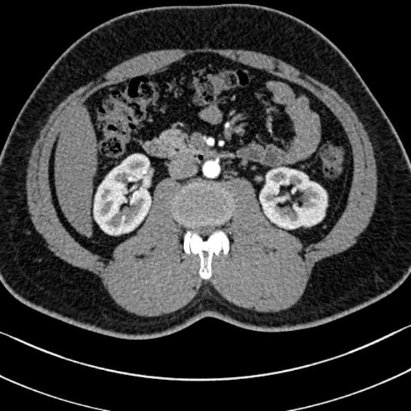 Normal kidneys on 4-phase CT study (Radiopaedia 25889-26038 B 49).jpg
