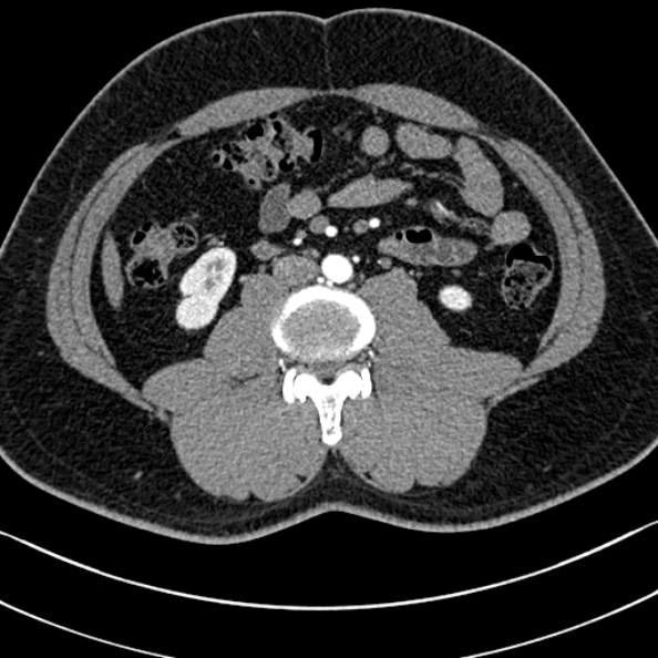 Normal kidneys on 4-phase CT study (Radiopaedia 25889-26038 B 71).jpg