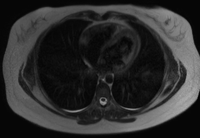 File:Normal liver MRI with Gadolinium (Radiopaedia 58913-66163 Axial T2 34).jpg