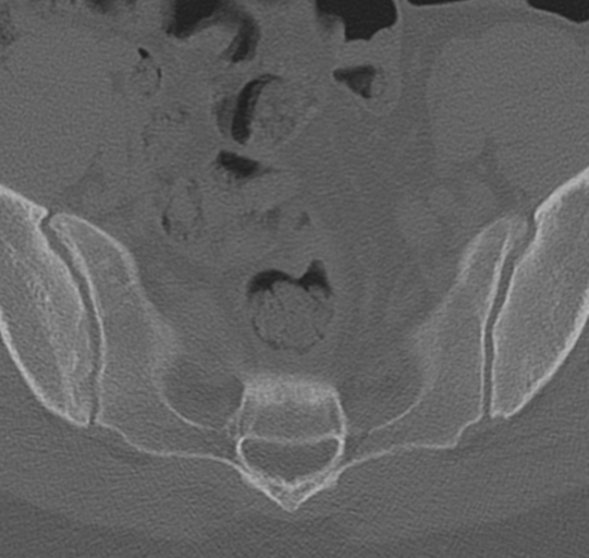 File:Normal lumbar spine CT (Radiopaedia 46533-50986 Axial bone window 78).png