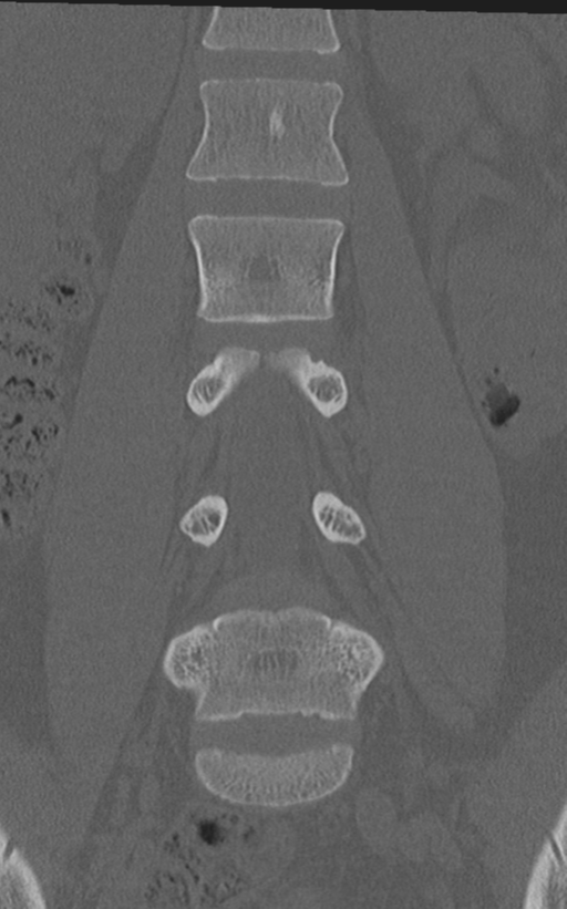 Normal lumbar spine CT (Radiopaedia 46533-50986 Coronal bone window 34).png