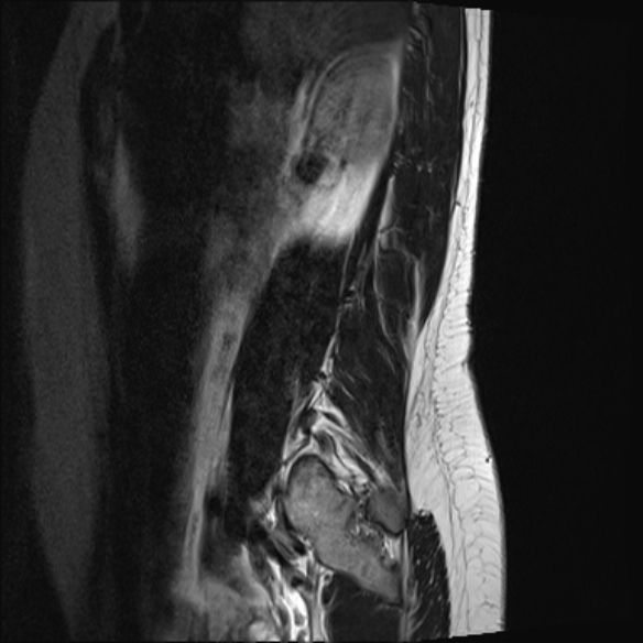 File:Normal lumbar spine MRI- 3 T (Radiopaedia 53280-59250 Sagittal T2 2).jpg