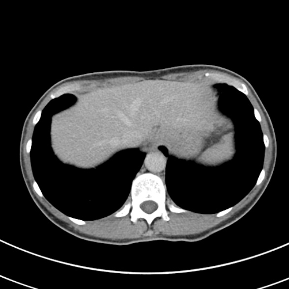 File:Normal multiphase CT liver (Radiopaedia 38026-39996 Axial C+ delayed 9).jpg
