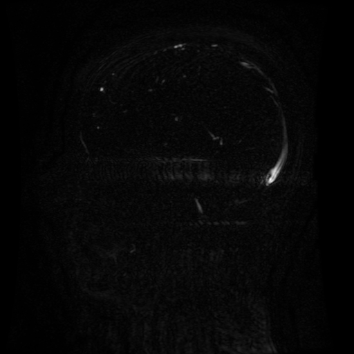 Normal noncontrast MR venography (Radiopaedia 87578-103957 A 93).jpg