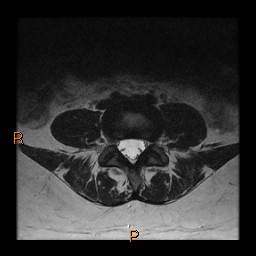 File:Normal spine MRI (Radiopaedia 77323-89408 Axial T2 16).jpg