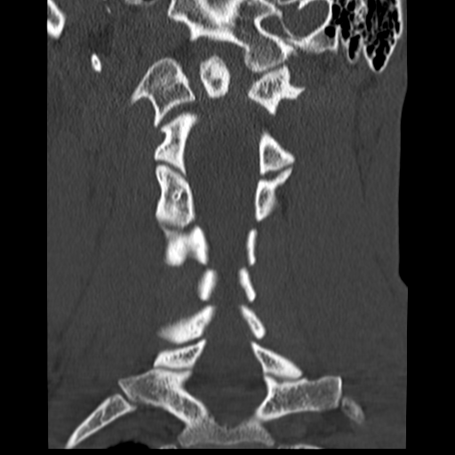 File:Normal trauma cervical spine (Radiopaedia 41017-43760 Coronal bone window 22).png