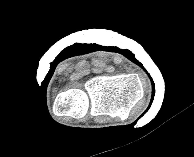 Normal wrist CT (Radiopaedia 41425-44297 Axial non-contrast 38).png