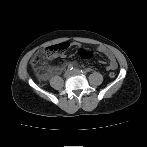 File:Obstructed kidney with perinephric urinoma (Radiopaedia 26889-27066 Axial non-contrast 41).jpg