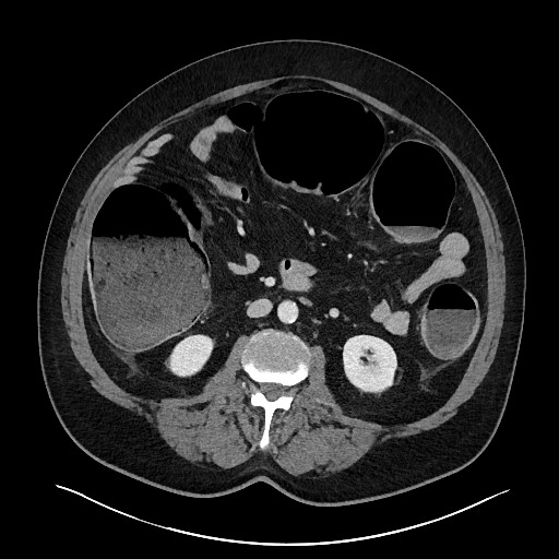 File:Obstructing sigmoid adenocarcinoma (Radiopaedia 58465-65619 A 80).jpg