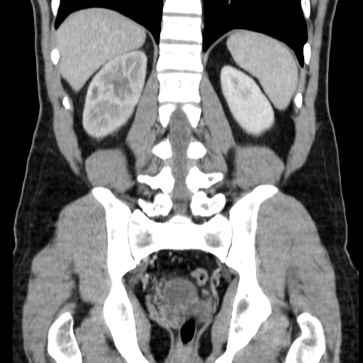 File:Obstructing ureteric calculus (Radiopaedia 18615-18514 C 57).jpg