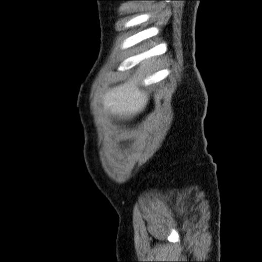 Obstructing ureteric calculus (Radiopaedia 49281-54373 C 81).jpg