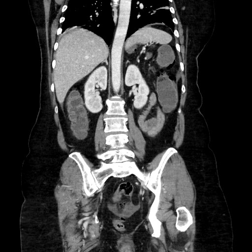 Obstructive distal colonic adenocarcinoma causing cecal perforation (Radiopaedia 86830-102989 C 118).jpg