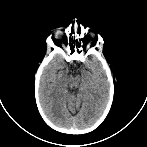 Occipital encephalocele (Radiopaedia 87339-103636 Axial non-contrast 32).jpg