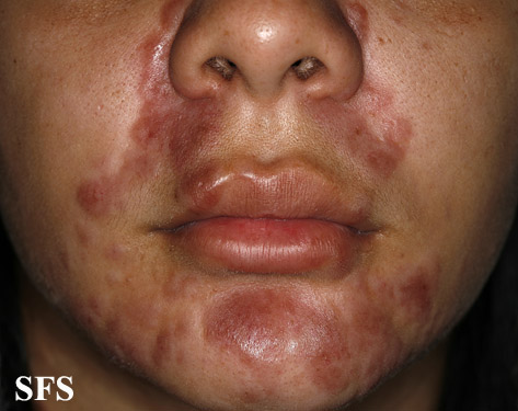 File:Sarcoidosis (Dermatology Atlas 24).jpg