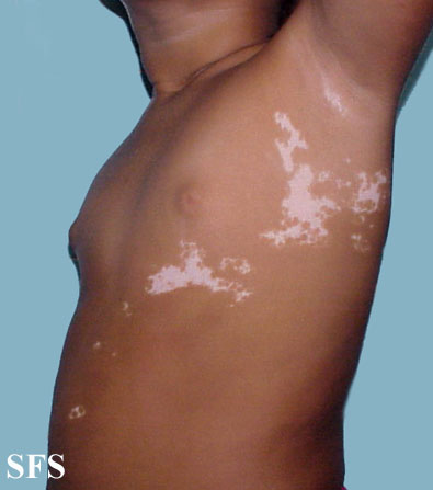 File:Vitiligo (Dermatology Atlas 23).jpg