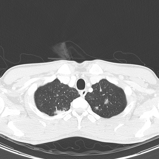 AIDS-related Kaposi sarcoma (Radiopaedia 85247-100811 Axial lung window 19).jpg
