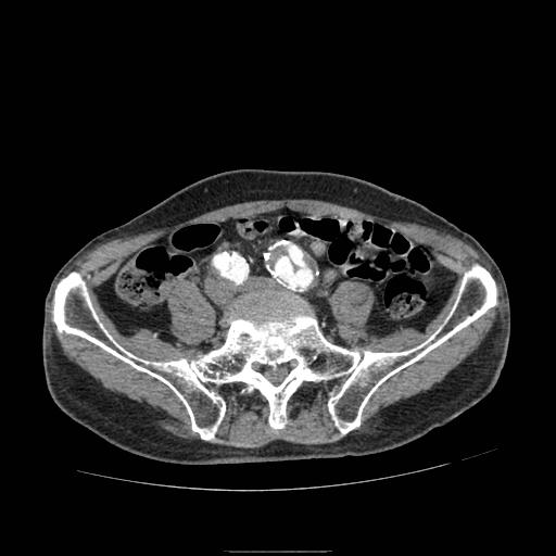 File:Abdominal aortic aneurysm (Radiopaedia 13341-13340 Axial C+ arterial phase 167).jpg