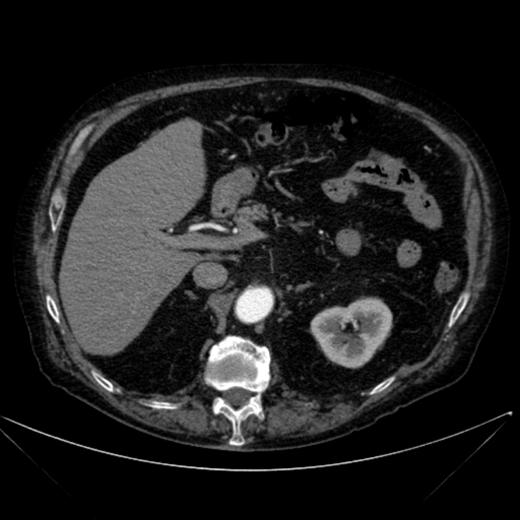 Abdominal aortic aneurysm (Radiopaedia 25855-26001 Axial C+ arterial phase 44).jpg
