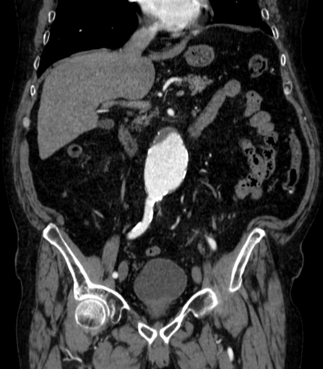 Abdominal aortic aneurysm (Radiopaedia 25855-26001 Coronal C+ arterial phase 26).jpg