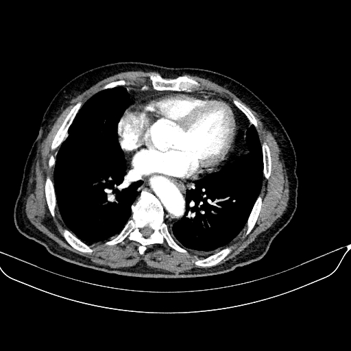 Abdominal aortic aneurysm (Radiopaedia 67117-76452 Axial C+ arterial phase 5).jpg