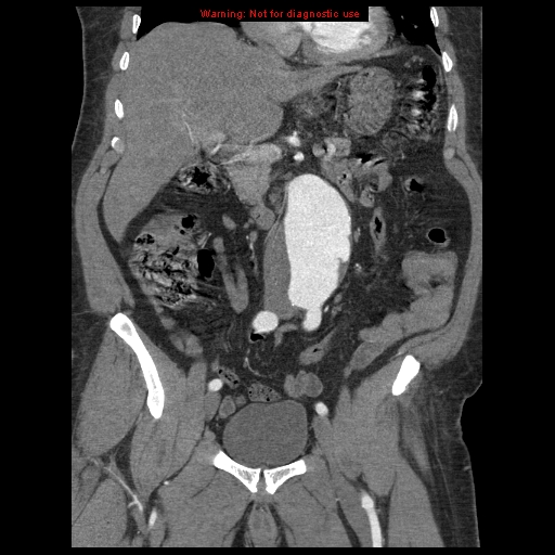 Abdominal aortic aneurysm (Radiopaedia 8190-9038 Coronal C+ arterial phase 54).jpg