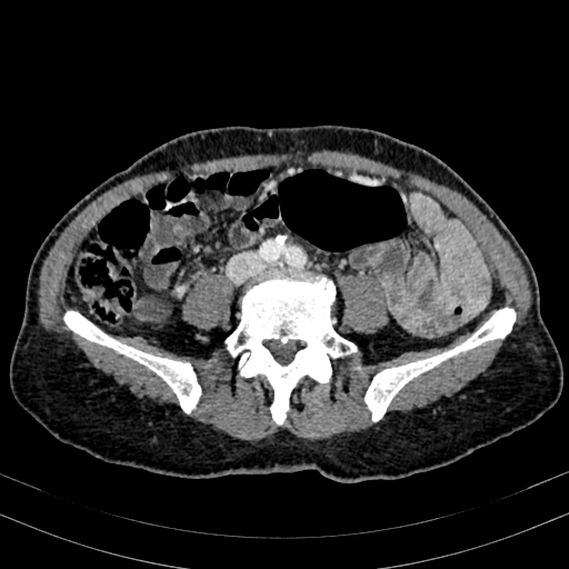 Abdominal aortic aneurysm (Radiopaedia 83581-98689 Axial C+ portal venous phase 71).jpg