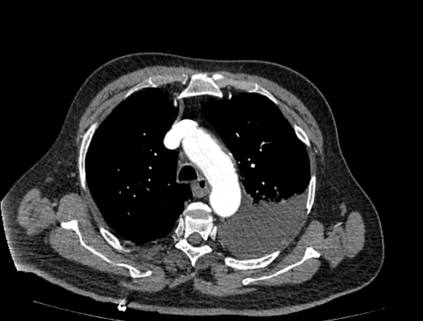 Abdominal aortic aneurysm rupture (Radiopaedia 54179-60362 Axial C+ arterial phase 5).jpg