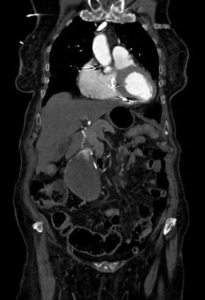 Abdominal aortic aneurysm with thrombus fissuration (Radiopaedia 73192-83919 Coronal C+ arterial phase 18).jpg