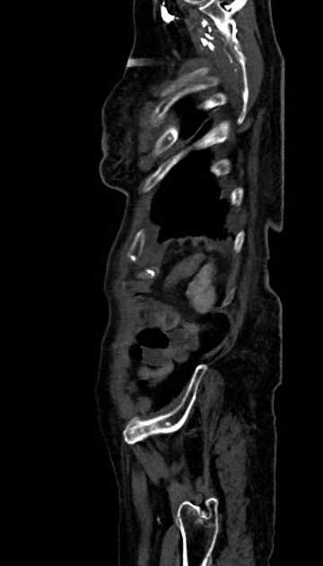 Abdominal aortic aneurysm with thrombus fissuration (Radiopaedia 73192-83919 Sagittal C+ arterial phase 8).jpg