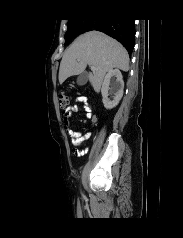 Abdominal lymphoma - with sandwich sign (Radiopaedia 53486-59492 Sagittal C+ portal venous phase 57).jpg