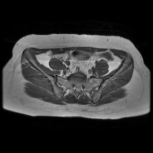 File:Abdominal wall endometriosis (Radiopaedia 83702-98847 Axial T1 3).jpg