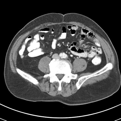 Abdominal wall metastasis from colorectal carcinoma (Radiopaedia 31016-31717 Axial C+ portal venous phase 47).jpg