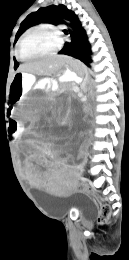 Abdominopelvic rhabdomyosarcoma (Radiopaedia 78356-90984 Sagittal C+ portal venous phase 39).jpg