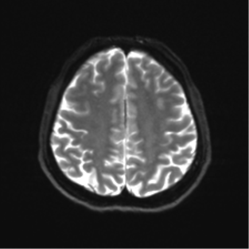Abducens nerve palsy (Radiopaedia 51069-56648 Axial DWI 20).png