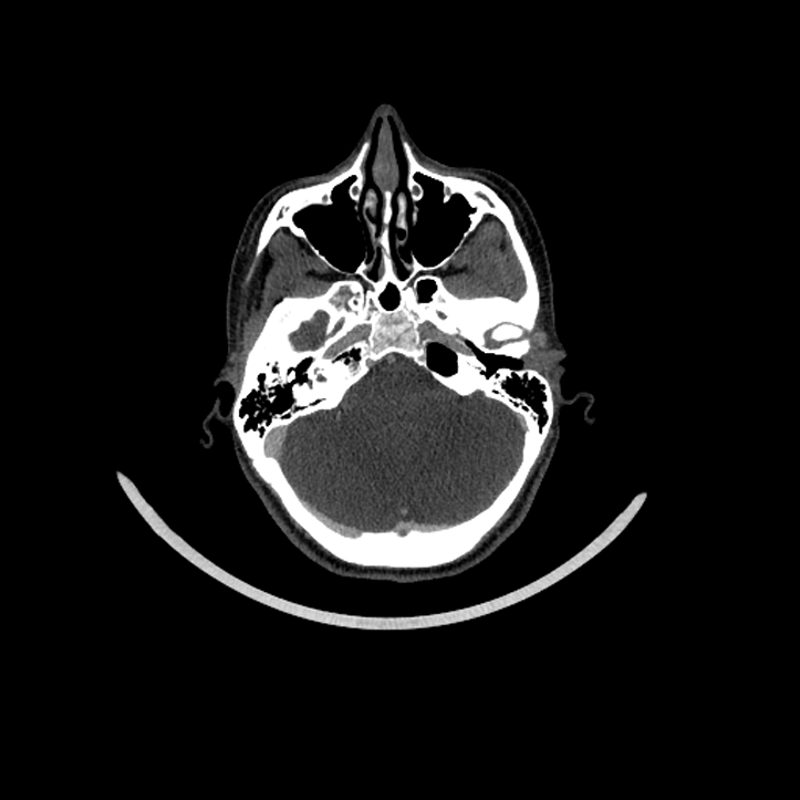 Aberrant right internal carotid artery (Radiopaedia 65191-74197 Axial C+ arterial phase 39).jpg
