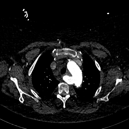 Aberrant right subclavian artery with Kommerell diverticulum (Radiopaedia 47982-52769 Axial C+ arterial phase 22).png
