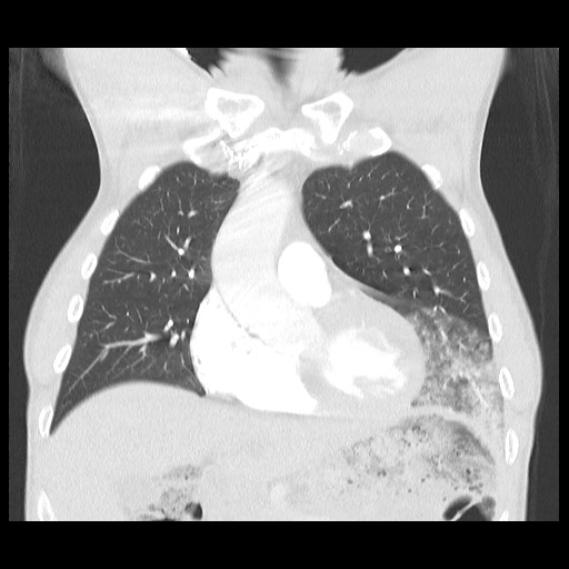 Accessory left horizontal fissure with lingular pneumonia (Radiopaedia 53763-59843 Coronal lung window 16).jpg