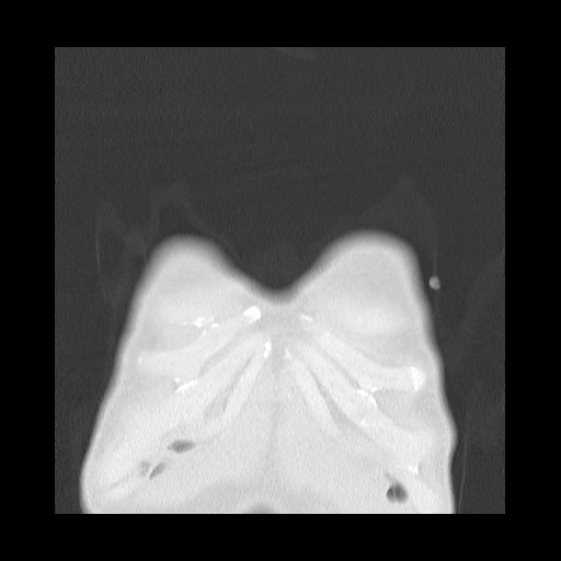 File:Accessory left horizontal fissure with lingular pneumonia (Radiopaedia 53763-59843 Coronal lung window 4).jpg