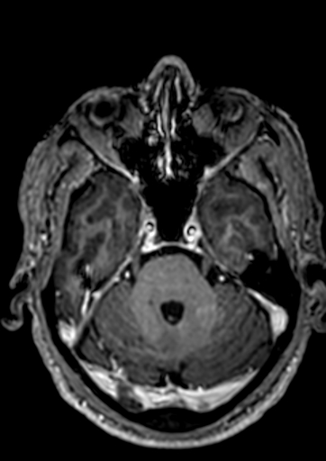 File:Accessory middle cerebral artery (Radiopaedia 73114-83828 Axial T1 C+ 112).jpg