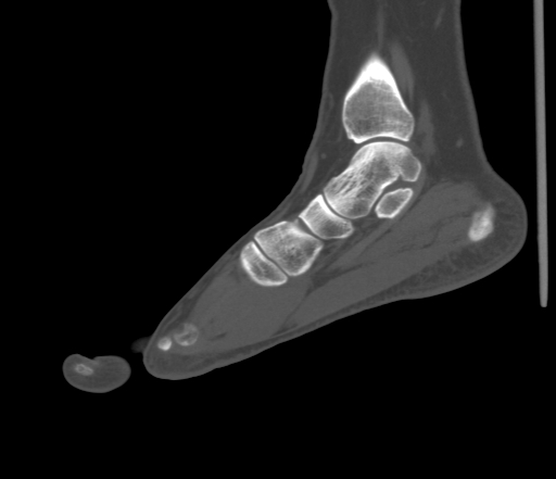 File:Accessory navicular bone (Radiopaedia 54999-61314 Sagittal non-contrast 53).jpg