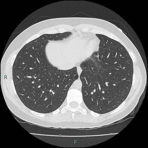 Accidental foreign body aspiration (seamstress needle) (Radiopaedia 77740-89983 Axial lung window 50).jpg