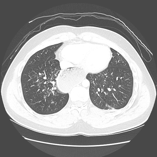 File:Achalasia (Radiopaedia 52507-58417 Axial lung window 45).jpg