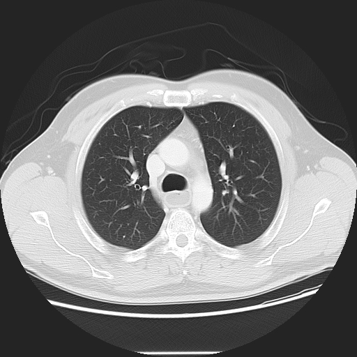 Achalasia (Radiopaedia 8831-9629 Axial lung window 23).jpg