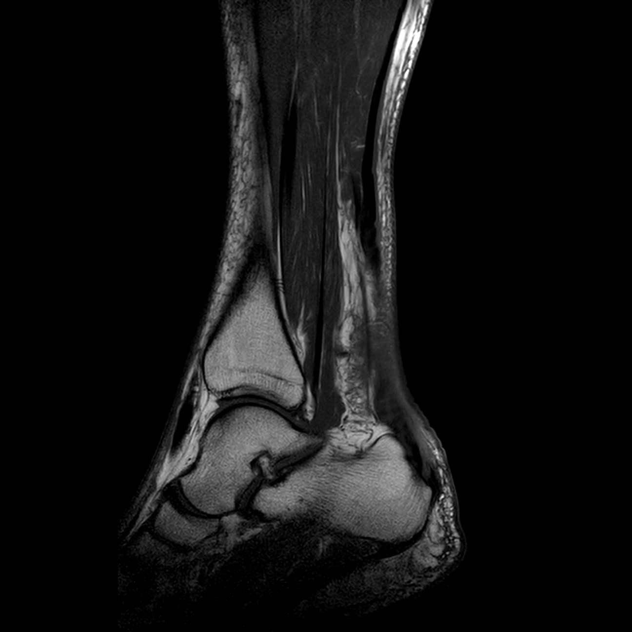 File:Achilles tendon rupture, complete (Radiopaedia 61601-69580 ...