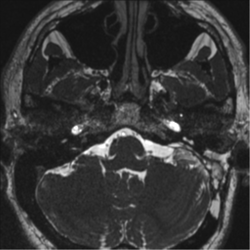 Acoustic schwannoma (translabyrinthine resection) (Radiopaedia 43570-46972 Axial CISS 20).png
