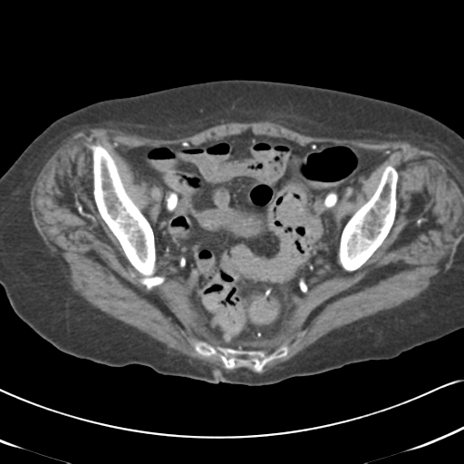 File:Active bleeding from duodenal ulcer with embolization (Radiopaedia 34216-35481 Axial C+ arterial phase 55).png