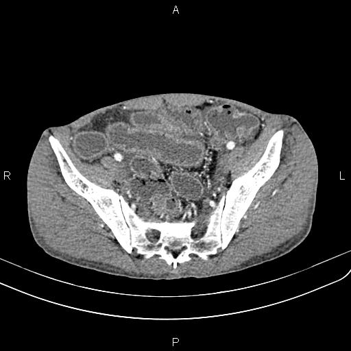 File:Active crohn disease (Radiopaedia 87133-103397 Axial C+ arterial phase 84).jpg