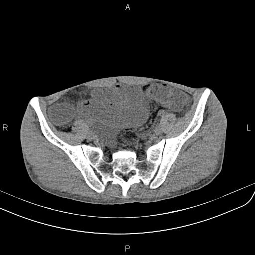 File:Active crohn disease (Radiopaedia 87133-103397 Axial non-contrast 80).jpg