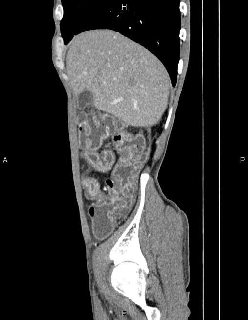 Active crohn disease (Radiopaedia 87133-103397 Sagittal C+ arterial phase 14).jpg